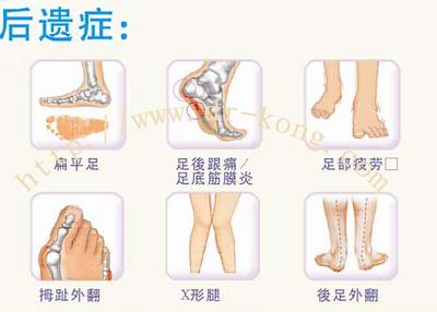 扁平足影响你一生