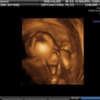 怀孕四个月左右的b超三维照片