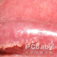 症状 珍珠丘疹 概述                      珍珠丘疹是在阴茎的冠状沟