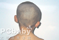 畸形可在生后即存在,也可在生后2～3周出现.