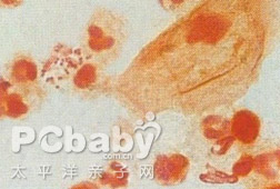 病因 淋球菌是neisser于1879年所发现,故又称奈瑟氏淋病双球菌