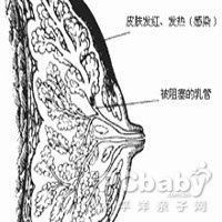 概述 疾病 产褥期乳腺炎 (别名:瘀积性乳腺炎,化脓性乳腺炎) 概述