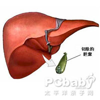 胆囊收缩功能不良