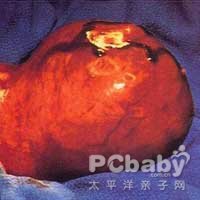 子宫内膜间质肉瘤