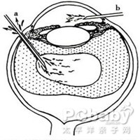 症状 玻璃体经瞳孔向前房凸出(别名:玻璃体疝)