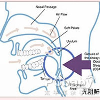 大舌头矫正的成因与危害
