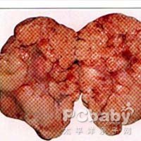 卵巢颗粒细胞瘤24例临床分析