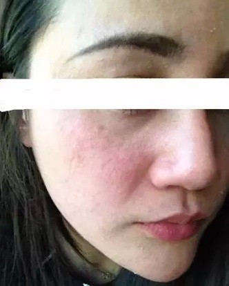 激素性皮炎vs季节性过敏!你分得清吗?