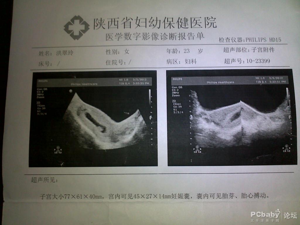 早孕测男女最准的方法,刚怀孕把脉怎么才能测男女