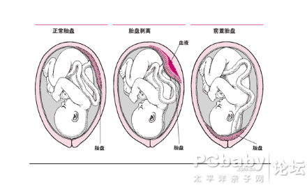 胎盘血窦覆盖宫颈