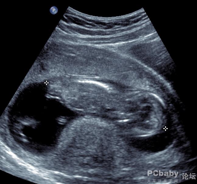 孕12w关于子宫形状的疑问