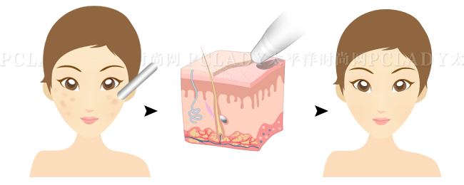 微晶磨皮祛痘印