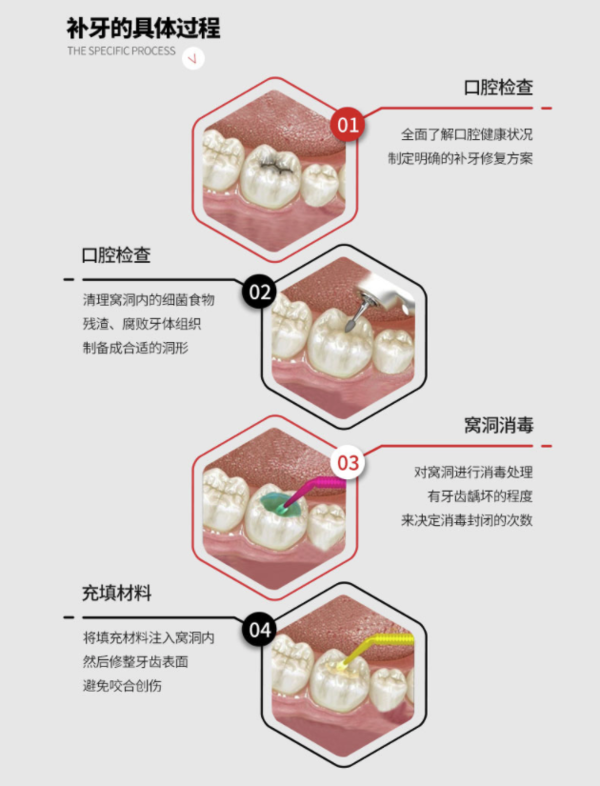 牙博士口腔3mz350进口光固化复合树脂补牙99元需用券