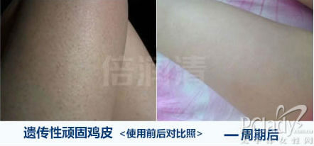 腿上有鸡皮肤应该怎么办_太平洋女性网